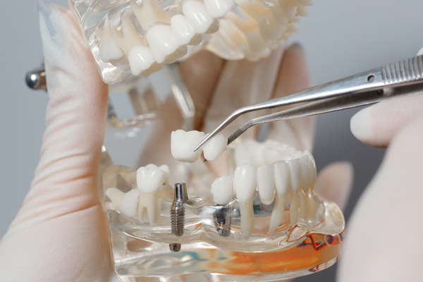 How To Know You Are A Candidate For Dental Implants