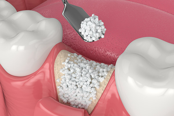 What To Know About The Dental Implant Process